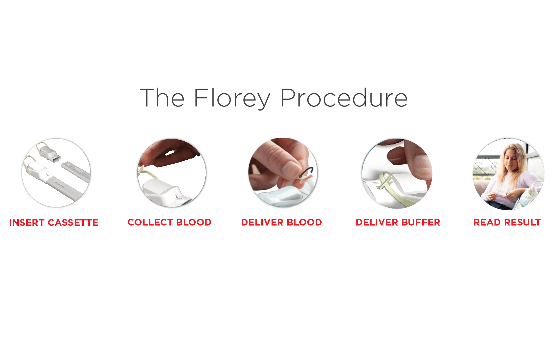 Florey-Procedure The Florey procedure illustrated in various stages, showcasing the surgical process and techniques involved.
